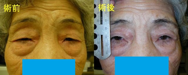 眼瞼皮膚切除
