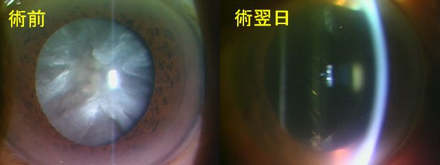過熟白内障